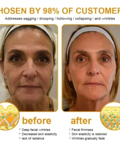 AllyBee™ Botox Bee Venom Wrinkle Removal Cream